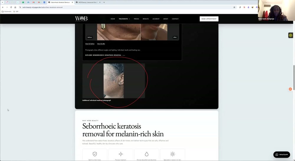 Call frame: the seborrhoeic keratosis page with a standalone image circled in red